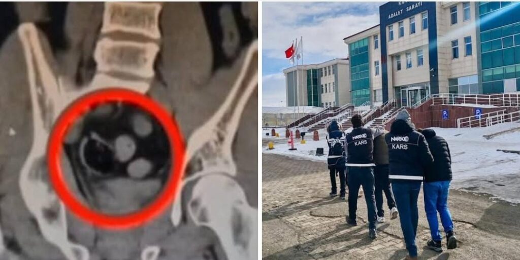 Kars’ta İranlı 3 kişinin bağırsağında uyuşturucu ele geçirildi – Birlik Haber Ajansı