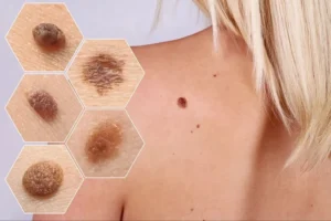 “Ben”im var diye sevinmeyin! Kanser olabilirsiniz