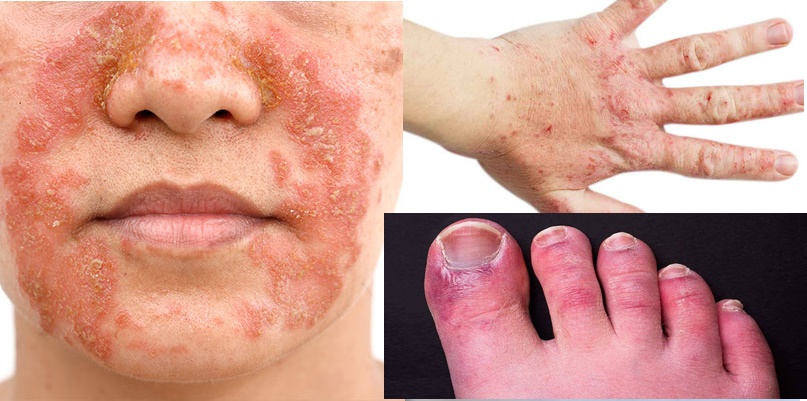 Uluslararası Tıp Dünyası da Uyarıyor: “Dermatit Vakaları Artıyor